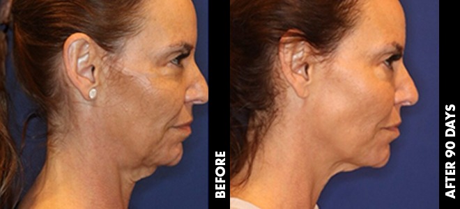 Before and after Ultherapy Prime: jawline and neck lift, side profile, 90 days